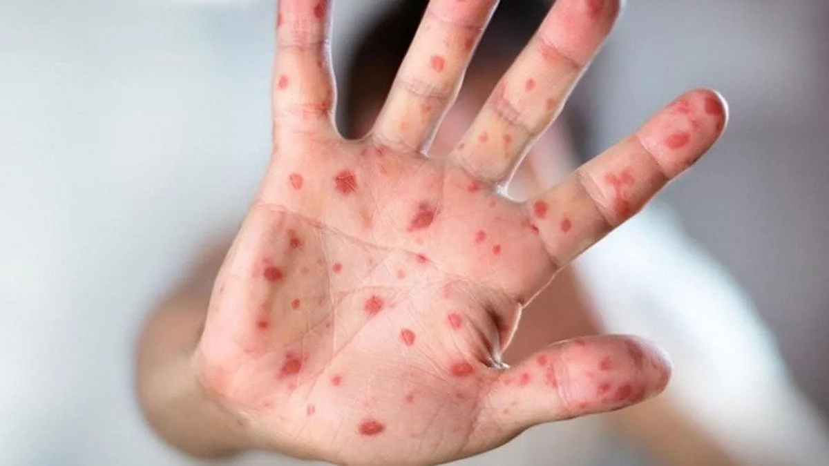 مدغشقر تسجل ارتفاعاً في إصابات جدري القردة وسط جهود احتواء الوباء